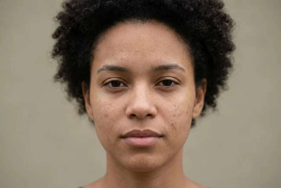 Antes — Antes e depois de skincare